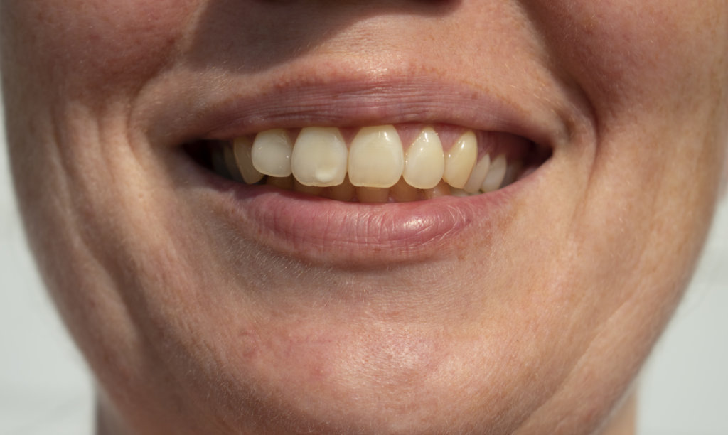 Different Types Of White Spots On Teeth And What They Mean Hancock Village Dental